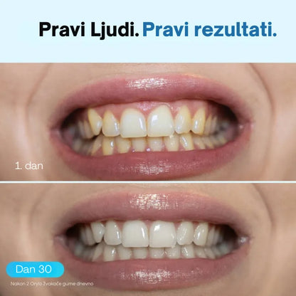 Žvakaća guma za izbjeljivanje zubi