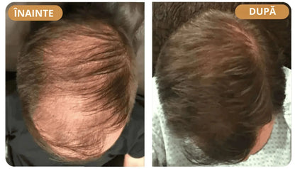 Шампоан за възстановяване на косата Orylo™ RootBoost